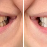 Sbiancamento denti Bari