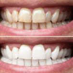 Sbiancamento denti Brescia