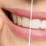 Sbiancamento denti Cuneo
