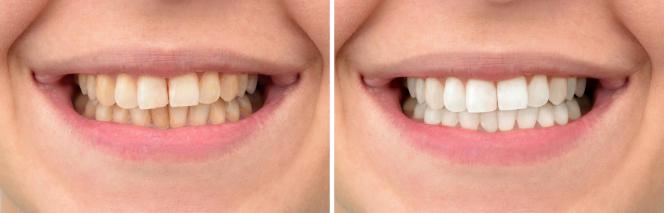 Sbiancamento denti Bari Sbiancamento denti Bari