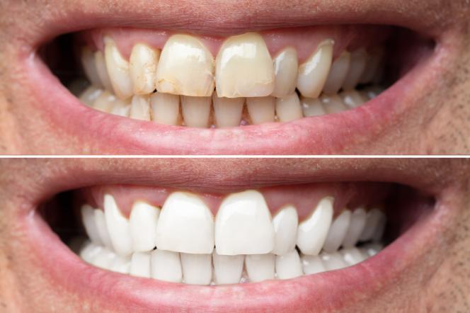 Sbiancamento denti Brescia Sbiancamento denti Brescia