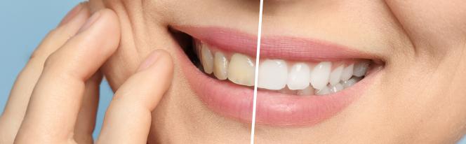 Sbiancamento denti Cuneo Sbiancamento denti Cuneo